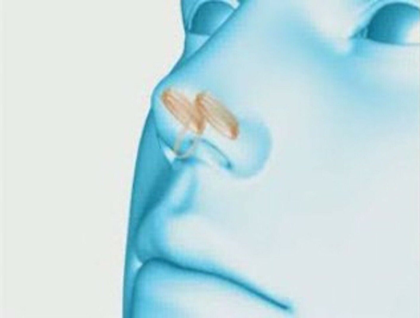 7X anti Snoring Aids Breathe Sleep Brez Nasal Dilators Stop No Strip Nose Vent